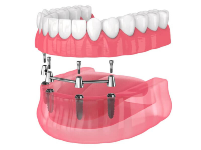 dantu atstatymas ant 4 implantu apacia