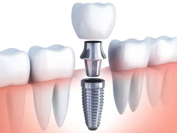 Dantų implantacija kas tai